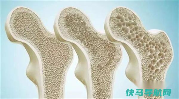 骨质疏松不能吃花生吗医生:若想养骨 2菜建议撤下饭桌 第2张