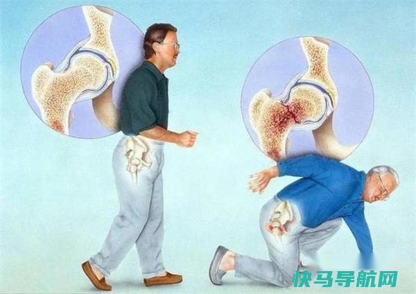 骨质疏松不能吃花生吗医生:若想养骨 2菜建议撤下饭桌 第3张